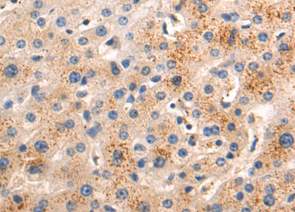 The image on the left is immunohistochemistry of paraffin-embedded Human liver cancer tissue using CSB-PA196650 (MFSD2A Antibody) at dilution 1/50, on the right is treated with synthetic peptide. (Original magnification: ×200)