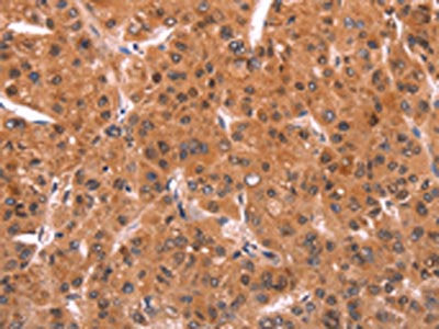 The image on the left is immunohistochemistry of paraffin-embedded Human liver cancer tissue using CSB-PA196695(EMP2 Antibody) at dilution 1/20, on the right is treated with synthetic peptide. (Original magnification: ×200)
