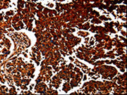 The image is immunohistochemistry of paraffin-embedded Human lung cancer tissue using CSB-PA196764(ANXA7 Antibody) at dilution 1/40. (Original magnification: ×200)