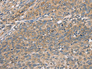 The image on the left is immunohistochemistry of paraffin-embedded Human cervical cancer tissue using CSB-PA196852(CST2 Antibody) at dilution 1/50, on the right is treated with fusion protein. (Original magnification: ×200)