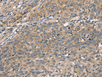 The image on the left is immunohistochemistry of paraffin-embedded Human cervical cancer tissue using CSB-PA196852(CST2 Antibody) at dilution 1/50, on the right is treated with fusion protein. (Original magnification: ×200)