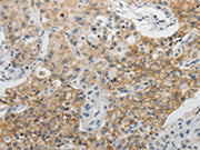 The image on the left is immunohistochemistry of paraffin-embedded Human lung cancer tissue using CSB-PA196946(CDH3 Antibody) at dilution 1/5, on the right is treated with fusion protein. (Original magnification: ×200)