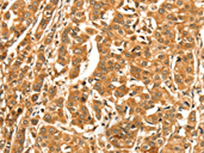 The image on the left is immunohistochemistry of paraffin-embedded Human breast cancer tissue using CSB-PA196950(DIRAS1 Antibody) at dilution 1/52, on the right is treated with synthetic peptide. (Original magnification: ×200)