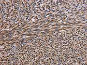 The image on the left is immunohistochemistry of paraffin-embedded Human sarcoma tissue using CSB-PA197107(KIF2A Antibody) at dilution 1/30, on the right is treated with fusion protein. (Original magnification: ×200)
