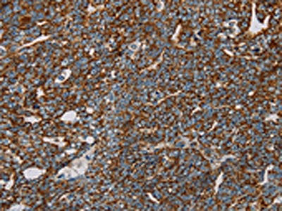 The image on the left is immunohistochemistry of paraffin-embedded Human cervical cancer tissue using CSB-PA197280(NDUFS3 Antibody) at dilution 1/30, on the right is treated with fusion protein. (Original magnification: ×200)