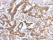 The image on the left is immunohistochemistry of paraffin-embedded Human colon cancer tissue using CSB-PA197500(ITGB5 Antibody) at dilution 1/25, on the right is treated with fusion protein. (Original magnification: ×200)