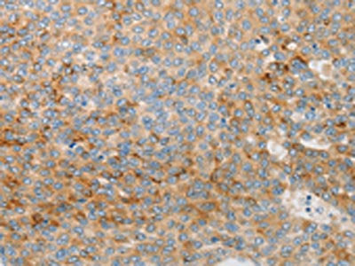 The image on the left is immunohistochemistry of paraffin-embedded Human liver cancer tissue using CSB-PA197609(IGFBP1 Antibody) at dilution 1/30, on the right is treated with synthetic peptide. (Original magnification: ×200)