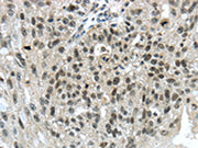 The image on the left is immunohistochemistry of paraffin-embedded Human breast cancer tissue using CSB-PA197772(TRIM24 Antibody) at dilution 1/40, on the right is treated with synthetic peptide. (Original magnification: ×200)
