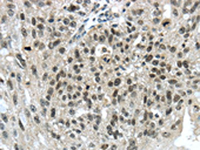 The image on the left is immunohistochemistry of paraffin-embedded Human breast cancer tissue using CSB-PA197772(TRIM24 Antibody) at dilution 1/40, on the right is treated with synthetic peptide. (Original magnification: ×200)