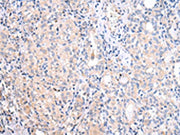 The image on the left is immunohistochemistry of paraffin-embedded Human thyroid cancer tissue using CSB-PA197802(ATF6 Antibody) at dilution 1/25, on the right is treated with synthetic peptide. (Original magnification: ×200)