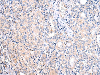 The image on the left is immunohistochemistry of paraffin-embedded Human thyroid cancer tissue using CSB-PA197802(ATF6 Antibody) at dilution 1/25, on the right is treated with synthetic peptide. (Original magnification: ×200)