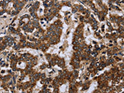 The image on the left is immunohistochemistry of paraffin-embedded Human liver cancer tissue using CSB-PA197834(FIS1 Antibody) at dilution 1/20, on the right is treated with fusion protein. (Original magnification: ×200)