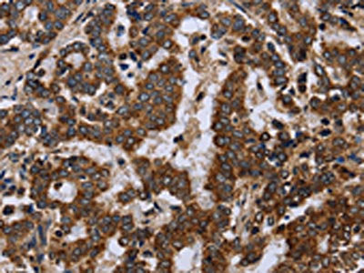 The image on the left is immunohistochemistry of paraffin-embedded Human liver cancer tissue using CSB-PA197834(FIS1 Antibody) at dilution 1/20, on the right is treated with fusion protein. (Original magnification: ×200)