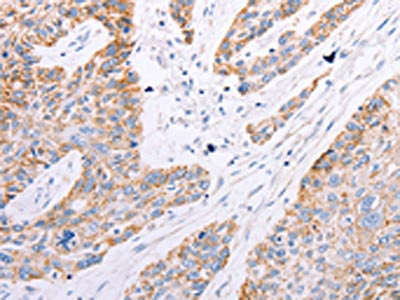 The image on the left is immunohistochemistry of paraffin-embedded Human esophagus cancer tissue using CSB-PA198099(GFRA3 Antibody) at dilution 1/60, on the right is treated with synthetic peptide. (Original magnification: ×200)
