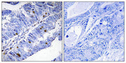 Immunohistochemical analysis of paraffin-embedded human colon carcinoma tissue using Nuclear Receptor NR4A1 (Phospho-Ser351) antibody (left)or the same antibody preincubated with blocking peptide (right).