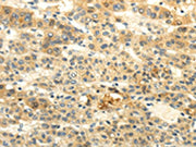 The image on the left is immunohistochemistry of paraffin-embedded Human liver cancer tissue using CSB-PA198192(BRWD1 Antibody) at dilution 1/20, on the right is treated with synthetic peptide. (Original magnification: ×200)
