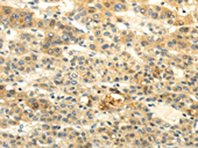 The image on the left is immunohistochemistry of paraffin-embedded Human liver cancer tissue using CSB-PA198192(BRWD1 Antibody) at dilution 1/20, on the right is treated with synthetic peptide. (Original magnification: ×200)