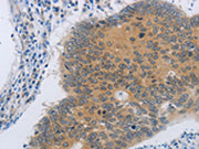 The image on the left is immunohistochemistry of paraffin-embedded Human colon cancer tissue using CSB-PA198208(NDRG4 Antibody) at dilution 1/45, on the right is treated with synthetic peptide. (Original magnification: ×200)