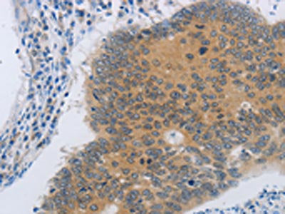 The image on the left is immunohistochemistry of paraffin-embedded Human colon cancer tissue using CSB-PA198208(NDRG4 Antibody) at dilution 1/45, on the right is treated with synthetic peptide. (Original magnification: ×200)