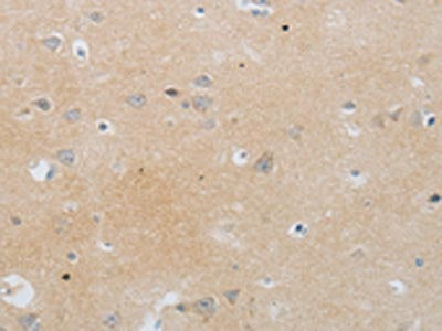 The image on the left is immunohistochemistry of paraffin-embedded Human brain tissue using CSB-PA198245(MMP25 Antibody) at dilution 1/80, on the right is treated with synthetic peptide. (Original magnification: ×200)