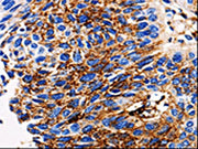 The image on the left is immunohistochemistry of paraffin-embedded Human lung cancer tissue using CSB-PA198249(ADAMTS5 Antibody) at dilution 1/10, on the right is treated with synthetic peptide. (Original magnification: ×200)