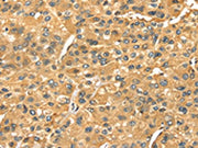 The image on the left is immunohistochemistry of paraffin-embedded Human liver cancer tissue using CSB-PA198452(SERPINB6 Antibody) at dilution 1/35, on the right is treated with fusion protein. (Original magnification: ×200)