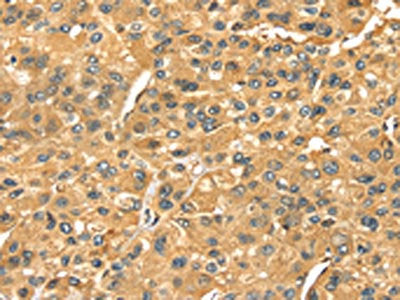 The image on the left is immunohistochemistry of paraffin-embedded Human liver cancer tissue using CSB-PA198452(SERPINB6 Antibody) at dilution 1/35, on the right is treated with fusion protein. (Original magnification: ×200)