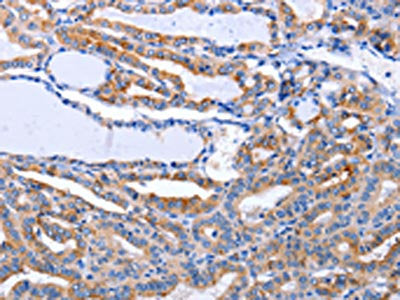 The image on the left is immunohistochemistry of paraffin-embedded Human thyroid cancer tissue using CSB-PA198481(LIF Antibody) at dilution 1/25, on the right is treated with synthetic peptide. (Original magnification: ×200)