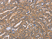 The image on the left is immunohistochemistry of paraffin-embedded Human thyroid cancer tissue using CSB-PA198566(CDCA4 Antibody) at dilution 1/50, on the right is treated with synthetic peptide. (Original magnification: ×200)