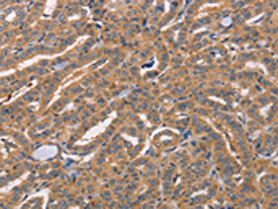 The image on the left is immunohistochemistry of paraffin-embedded Human thyroid cancer tissue using CSB-PA198566(CDCA4 Antibody) at dilution 1/50, on the right is treated with synthetic peptide. (Original magnification: ×200)