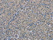 The image on the left is immunohistochemistry of paraffin-embedded Human thyroid cancer tissue using CSB-PA198612(EDN1 Antibody) at dilution 1/30, on the right is treated with fusion protein. (Original magnification: ×200)