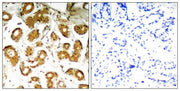 Immunohistochemical analysis of paraffin-embedded human breast carcinoma tissue using NFkB-p65(Ab-505) Antibody(left) or the same antibody preincubated with blocking peptide(right).