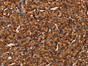 The image on the left is immunohistochemistry of paraffin-embedded Human prostate cancer tissue using CSB-PA199023(COL18A1 Antibody) at dilution 1/40, on the right is treated with synthetic peptide. (Original magnification: ×200)