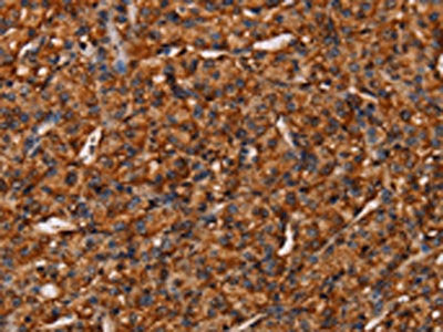 The image on the left is immunohistochemistry of paraffin-embedded Human prostate cancer tissue using CSB-PA199023(COL18A1 Antibody) at dilution 1/40, on the right is treated with synthetic peptide. (Original magnification: ×200)
