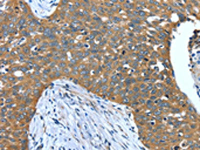 The image on the left is immunohistochemistry of paraffin-embedded Human cervical cancer tissue using CSB-PA199144(DTX1 Antibody) at dilution 1/40, on the right is treated with synthetic peptide. (Original magnification: ×200)
