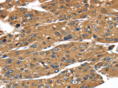 The image on the left is immunohistochemistry of paraffin-embedded Human liver cancer tissue using CSB-PA199259(TBX10 Antibody) at dilution 1/35, on the right is treated with fusion protein. (Original magnification: ×200)