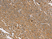 The image on the left is immunohistochemistry of paraffin-embedded Human cervical cancer tissue using CSB-PA199334(PTPN20B Antibody) at dilution 1/30, on the right is treated with synthetic peptide. (Original magnification: ×200)