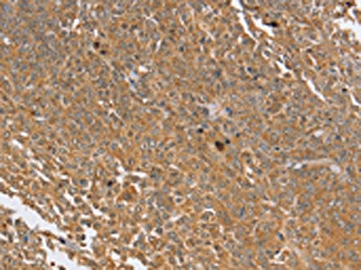 The image on the left is immunohistochemistry of paraffin-embedded Human cervical cancer tissue using CSB-PA199334(PTPN20B Antibody) at dilution 1/30, on the right is treated with synthetic peptide. (Original magnification: ×200)