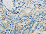 The image on the left is immunohistochemistry of paraffin-embedded Human thyroid cancer tissue using CSB-PA199353(TNFRSF12A Antibody) at dilution 1/10, on the right is treated with fusion protein. (Original magnification: ×200)