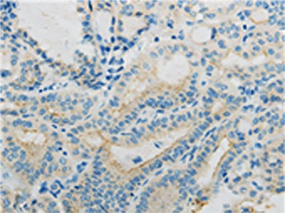 The image on the left is immunohistochemistry of paraffin-embedded Human thyroid cancer tissue using CSB-PA199353(TNFRSF12A Antibody) at dilution 1/10, on the right is treated with fusion protein. (Original magnification: ×200)