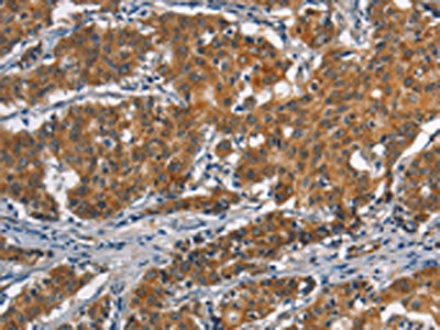 The image on the left is immunohistochemistry of paraffin-embedded Human gastic cancer tissue using CSB-PA199459(APOL1 Antibody) at dilution 1/40, on the right is treated with synthetic peptide. (Original magnification: ×200)
