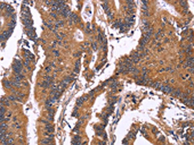 The image on the left is immunohistochemistry of paraffin-embedded Human colon cancer tissue using CSB-PA199577(SEPT7 Antibody) at dilution 1/50, on the right is treated with fusion protein. (Original magnification: ×200)