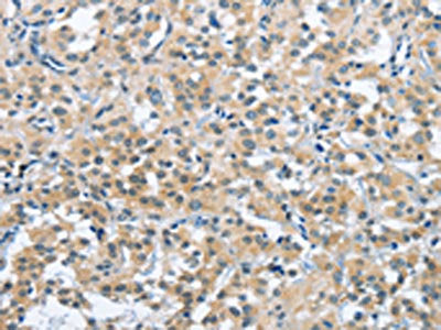 The image on the left is immunohistochemistry of paraffin-embedded Human thyroid cancer tissue using CSB-PA199904(TRDMT1 Antibody) at dilution 1/40, on the right is treated with synthetic peptide. (Original magnification: ×200)