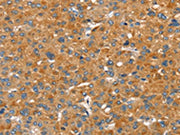 The image on the left is immunohistochemistry of paraffin-embedded Human liver cancer tissue using CSB-PA200109(SLC29A4 Antibody) at dilution 1/20, on the right is treated with fusion protein. (Original magnification: ×200)
