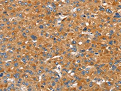 The image on the left is immunohistochemistry of paraffin-embedded Human liver cancer tissue using CSB-PA200109(SLC29A4 Antibody) at dilution 1/20, on the right is treated with fusion protein. (Original magnification: ×200)