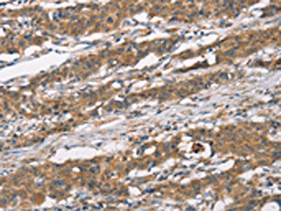 The image on the left is immunohistochemistry of paraffin-embedded Human gastic cancer tissue using CSB-PA200203(MARC1 Antibody) at dilution 1/40, on the right is treated with synthetic peptide. (Original magnification: ×200)
