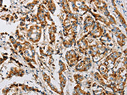 The image on the left is immunohistochemistry of paraffin-embedded Human breast cancer tissue using CSB-PA200236(IFITM3 Antibody) at dilution 1/25, on the right is treated with fusion protein. (Original magnification: ×200)
