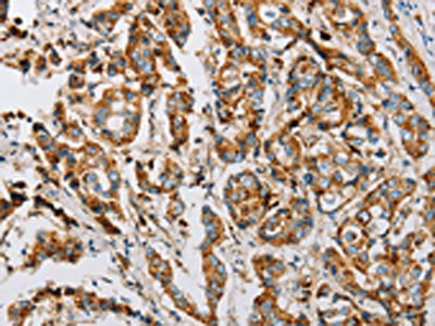 The image on the left is immunohistochemistry of paraffin-embedded Human breast cancer tissue using CSB-PA200236(IFITM3 Antibody) at dilution 1/25, on the right is treated with fusion protein. (Original magnification: ×200)