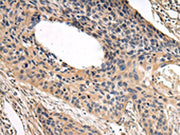 The image on the left is immunohistochemistry of paraffin-embedded Human esophagus cancer tissue using CSB-PA200282(USP15 Antibody) at dilution 1/35, on the right is treated with fusion protein. (Original magnification: ×200)
