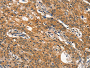 The image on the left is immunohistochemistry of paraffin-embedded Human gastic cancer tissue using CSB-PA200531(DNM2 Antibody) at dilution 1/40, on the right is treated with synthetic peptide. (Original magnification: ×200)